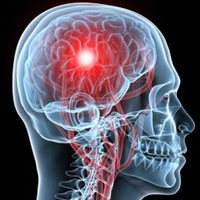 Ictus Ictus